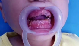 小孩嘴烂图片,揭秘嘴烂的常见原因及应对策略